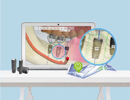 3D 디지털 활용 임플란트
